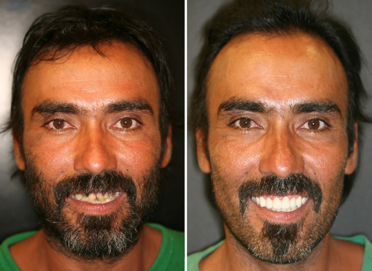 Smile Makeover Before and After Phoenix AZ