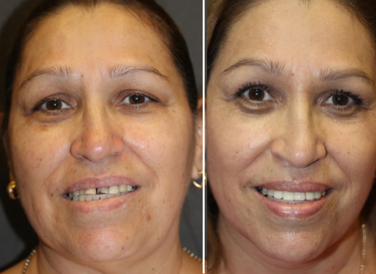 Dental Crowns Phoenix AZ