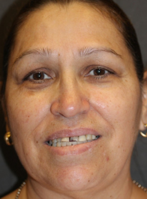 Before dental veneers Phoenix AZ — Zapata Dental patient