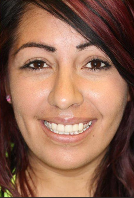 Patient smile transformation