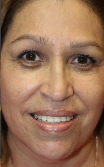 Patient smile transformation