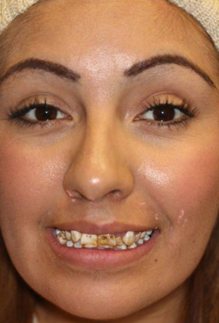 Smile makeover before — Zapata Dental Phoenix AZ