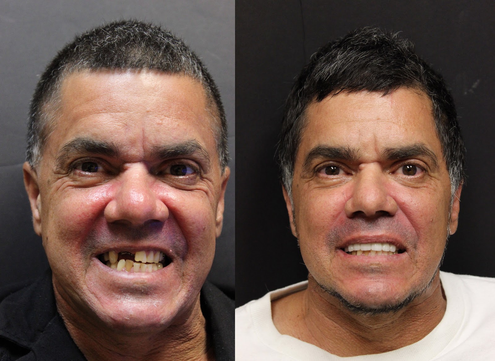 Patient smile result