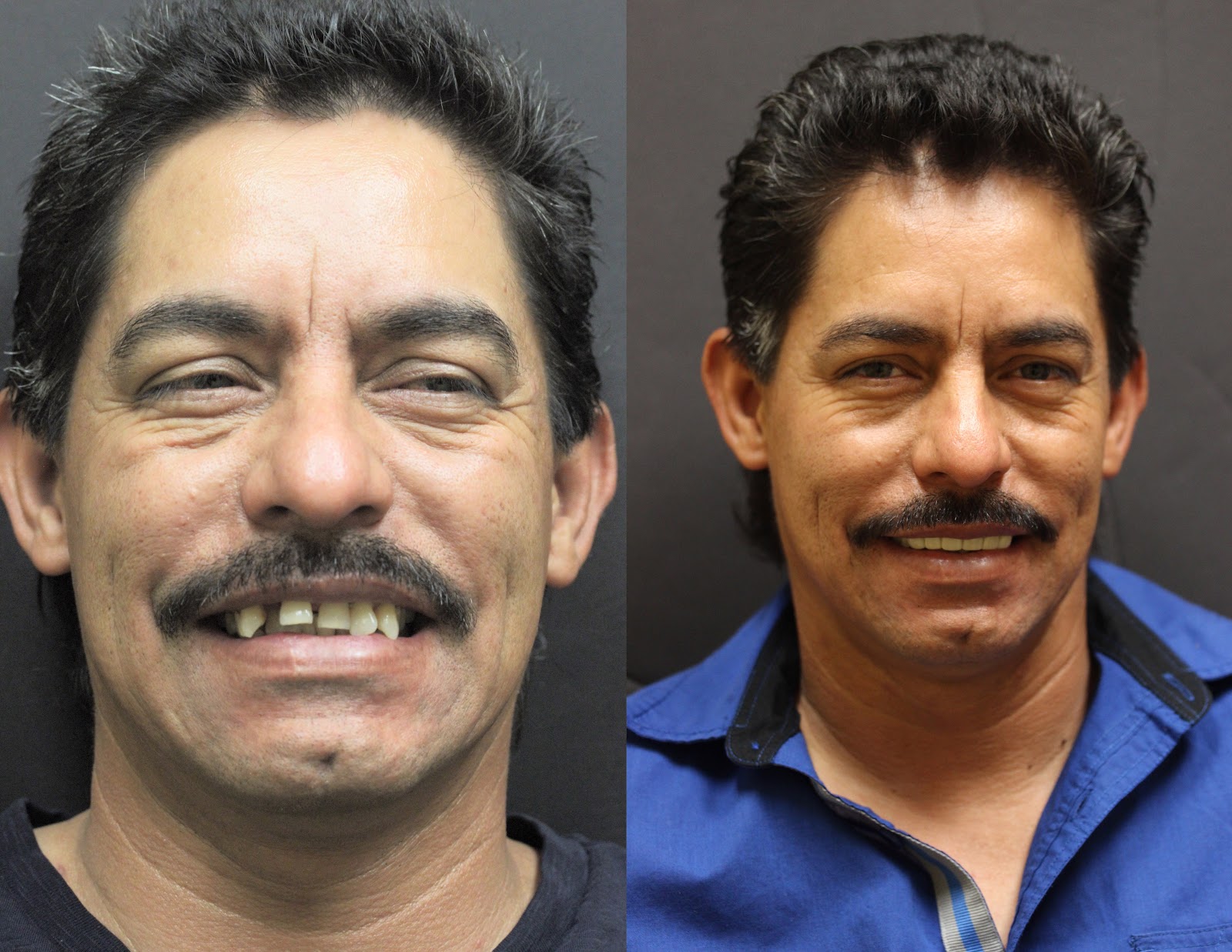Patient smile result