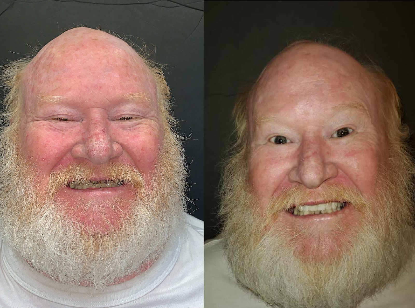 Patient smile result