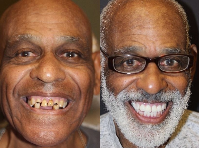 Patient smile result