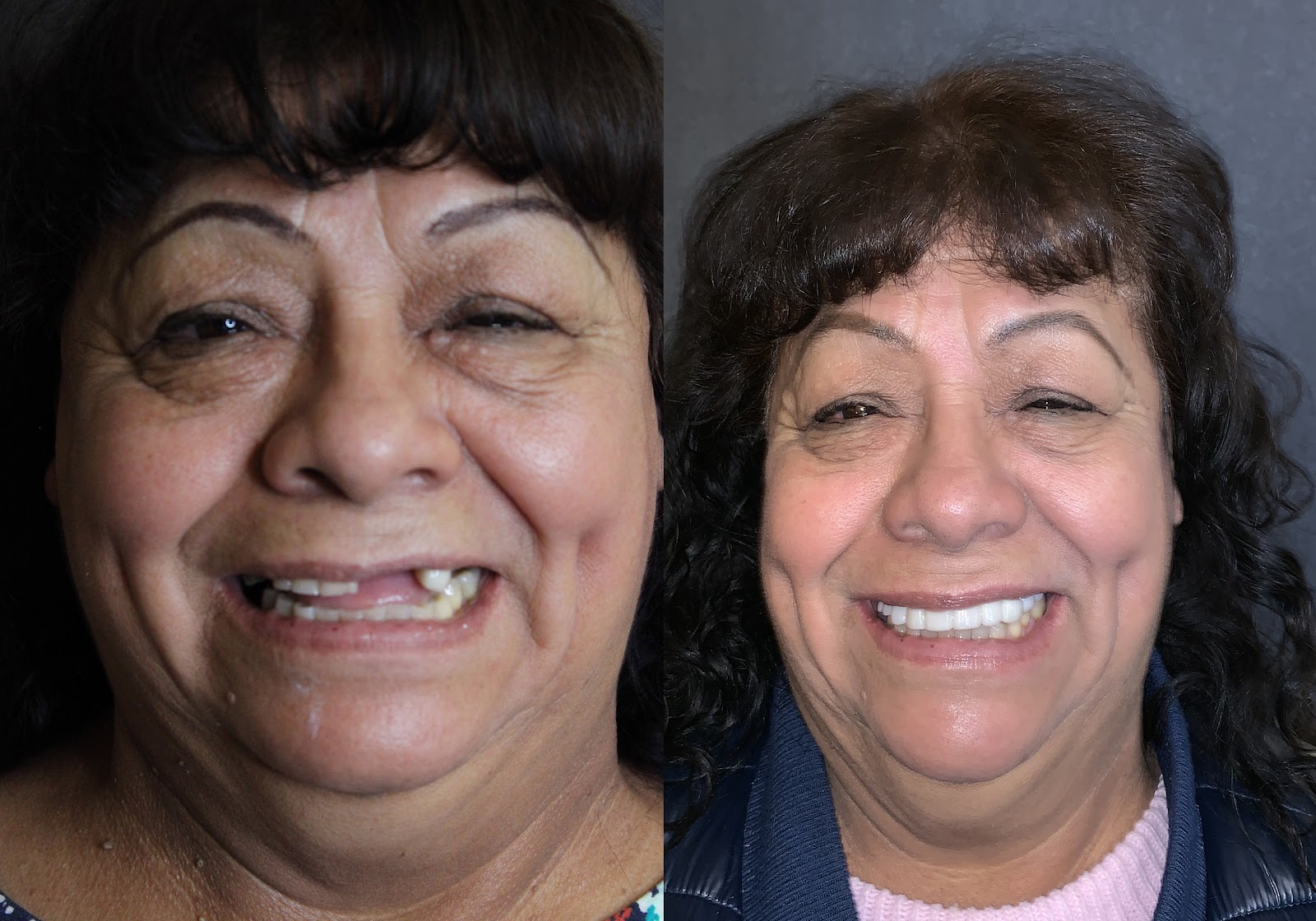 Patient smile result