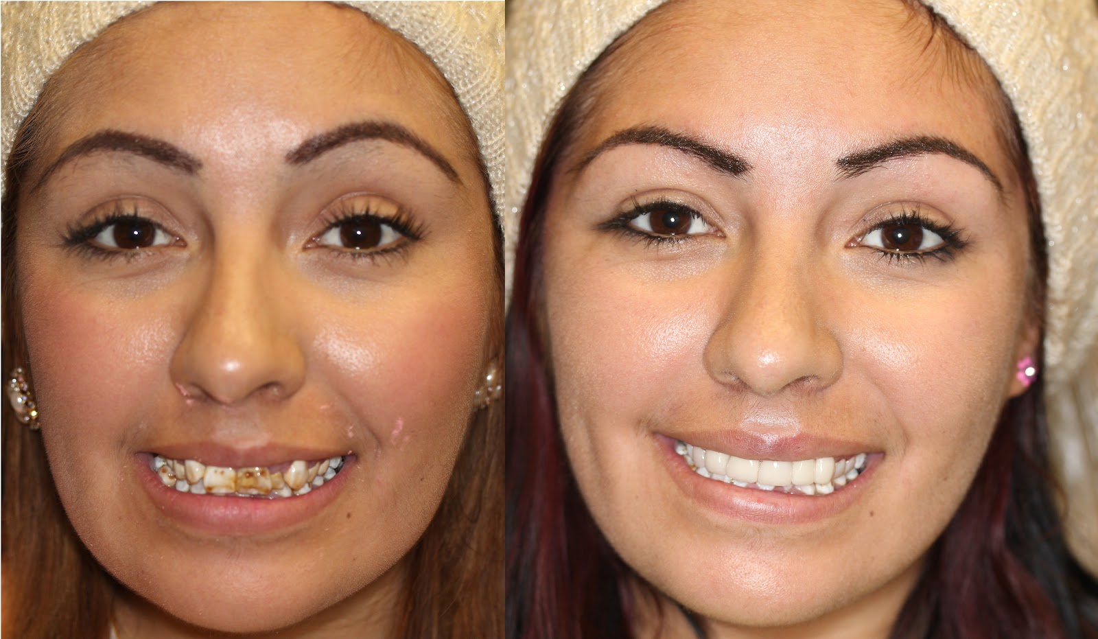 Patient smile result