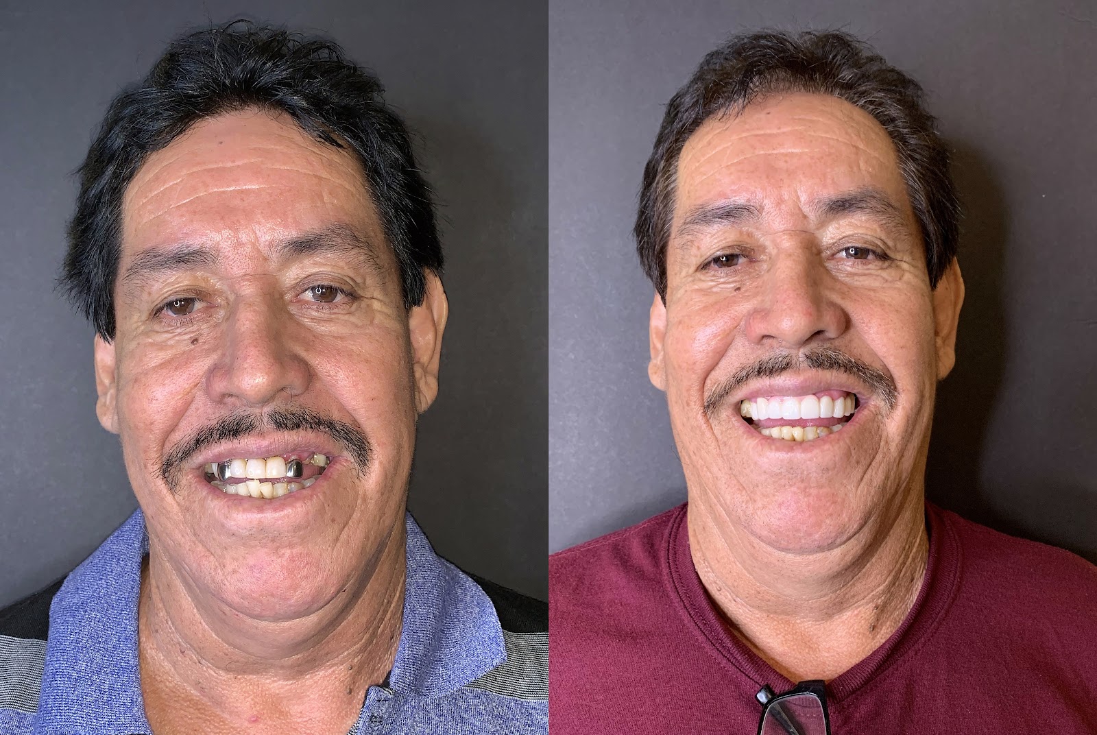 Patient smile result