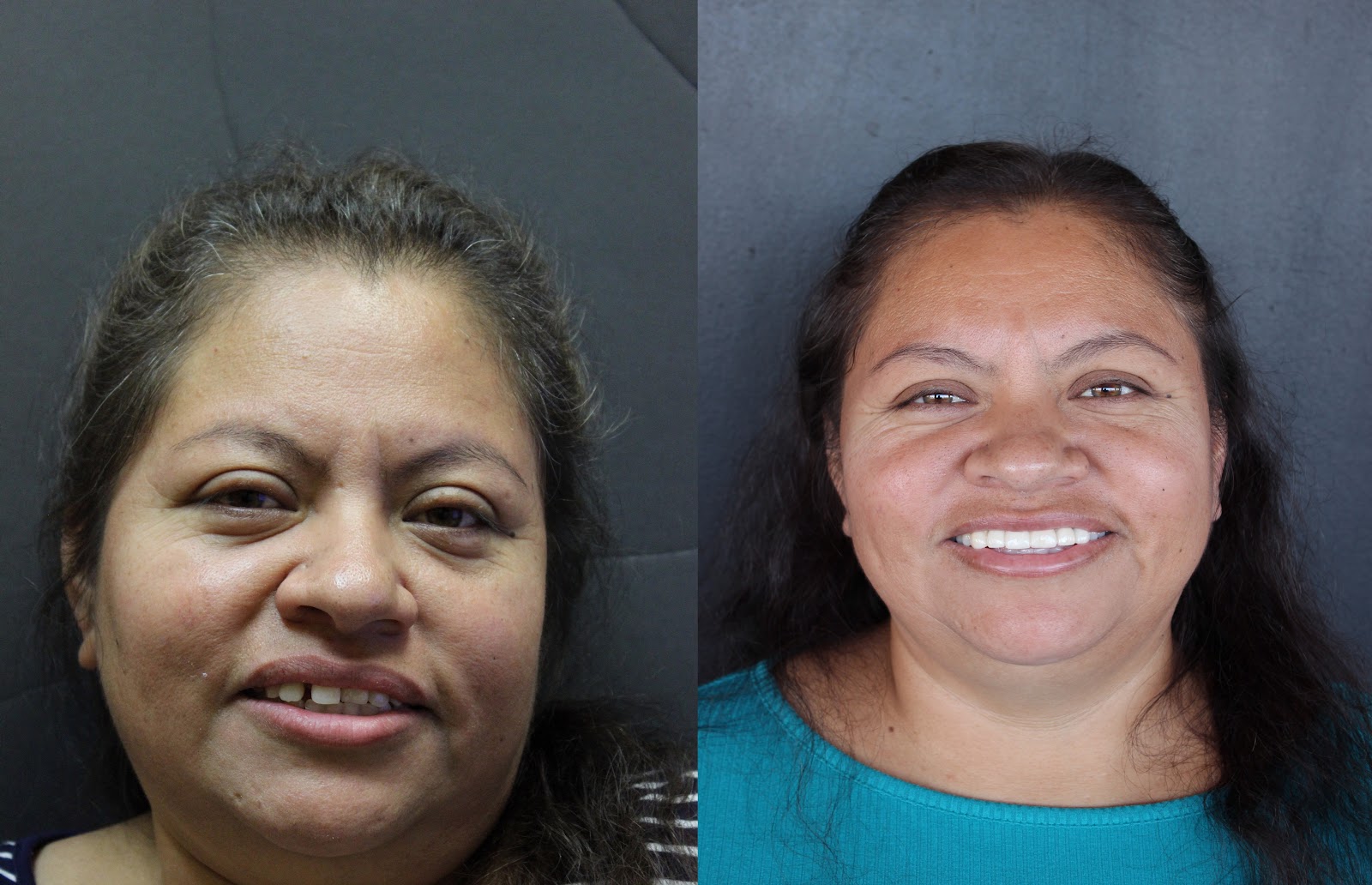 Patient smile result