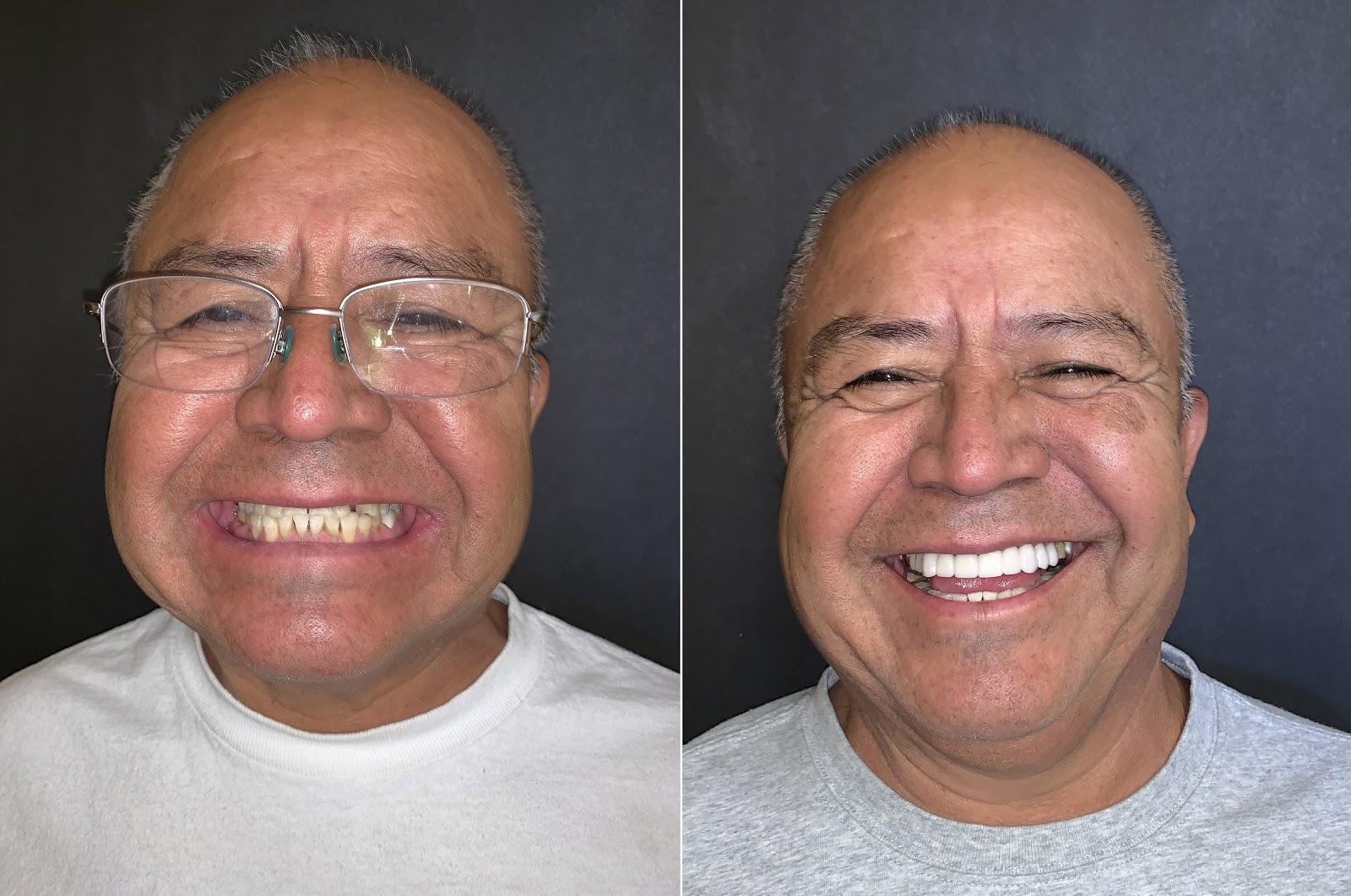 Patient smile result