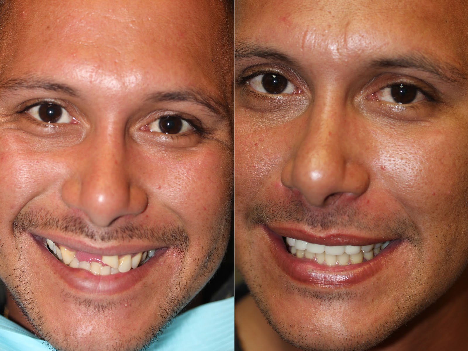 Patient smile result