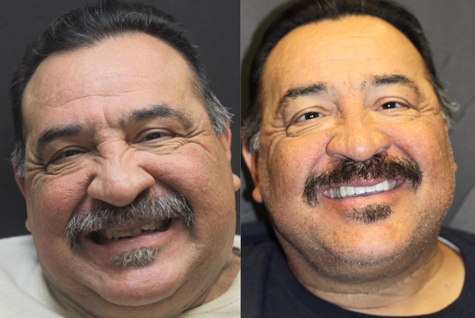 Patient smile result