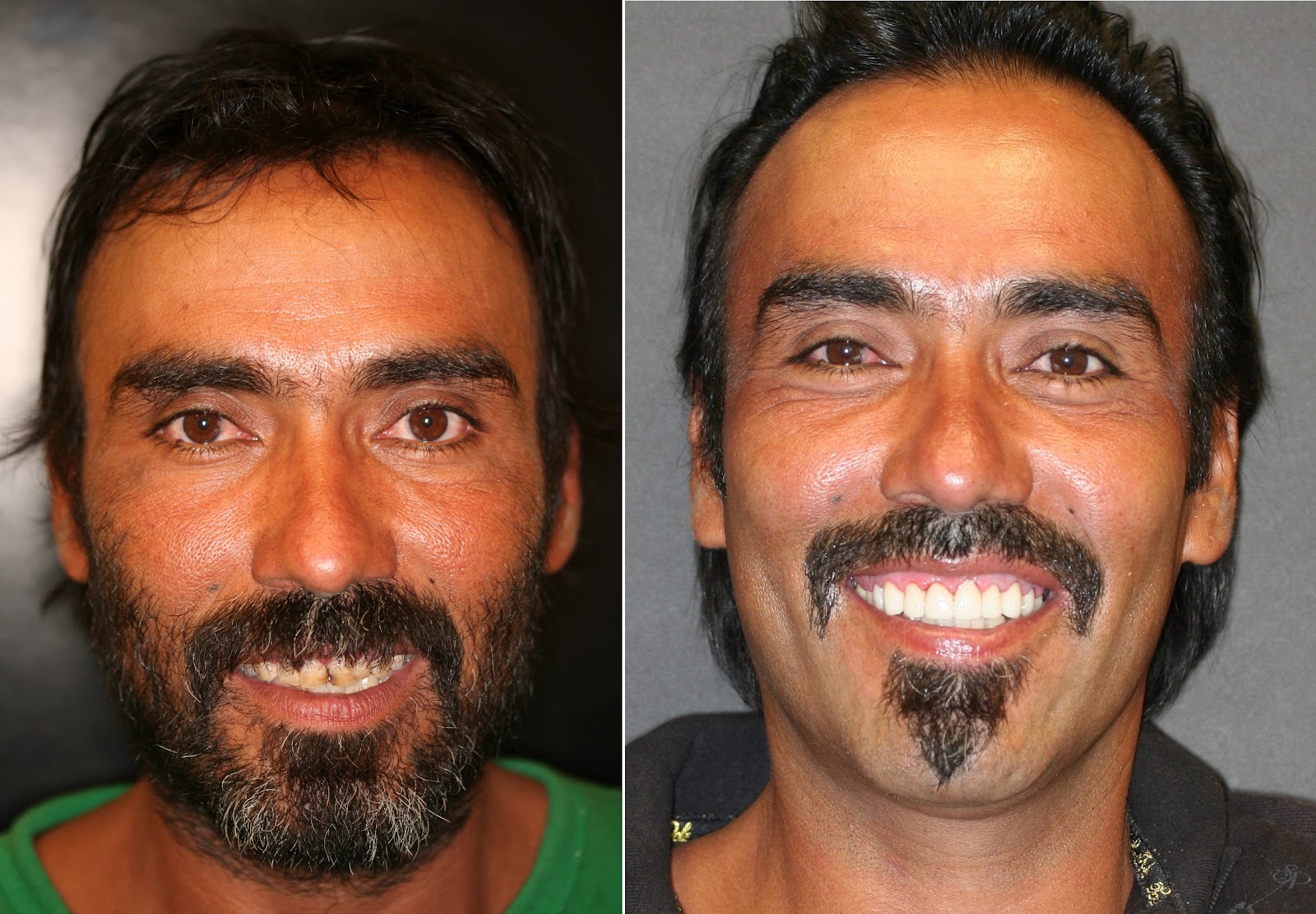 Patient smile result
