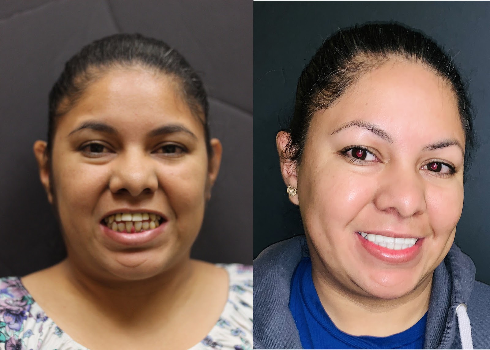 Patient smile result