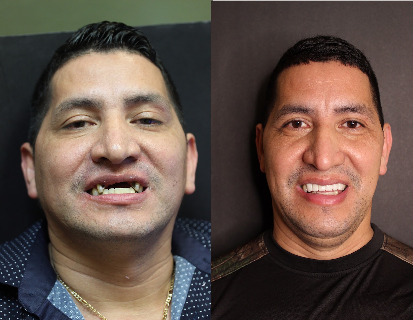 Patient smile result