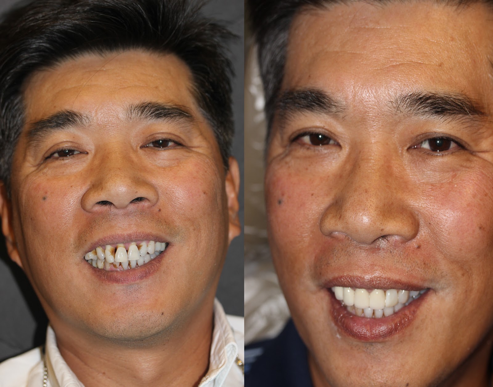 Patient smile result
