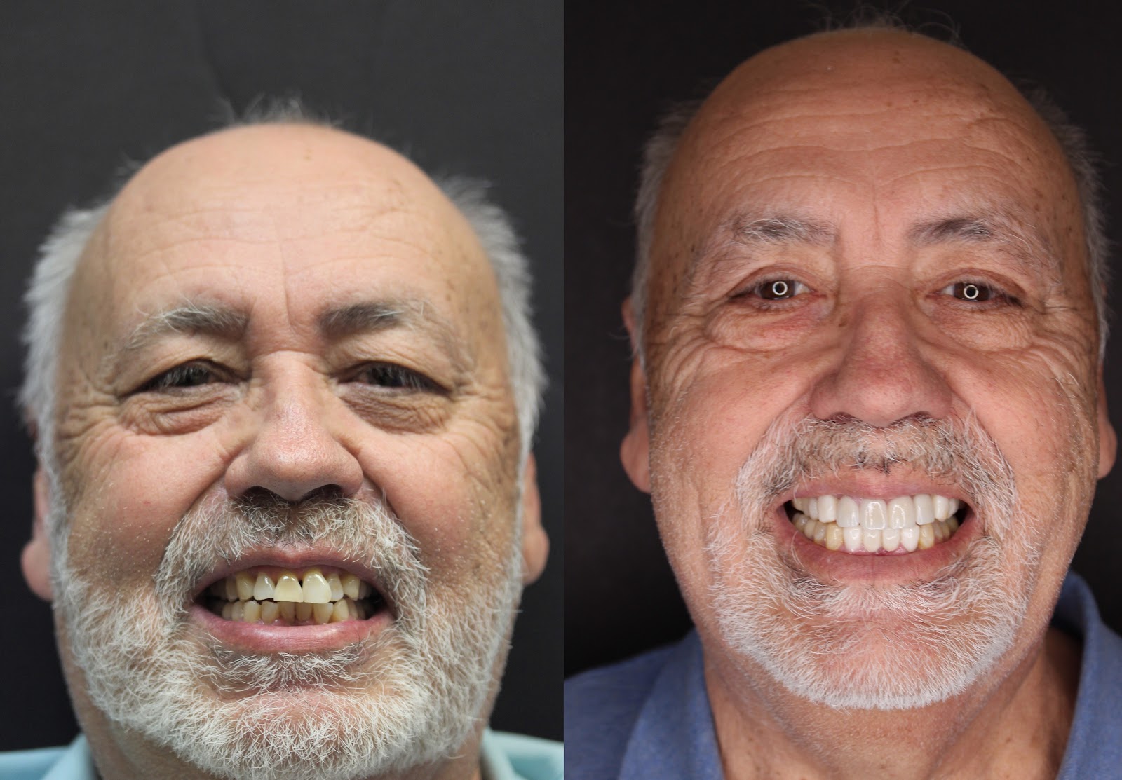 Patient smile result