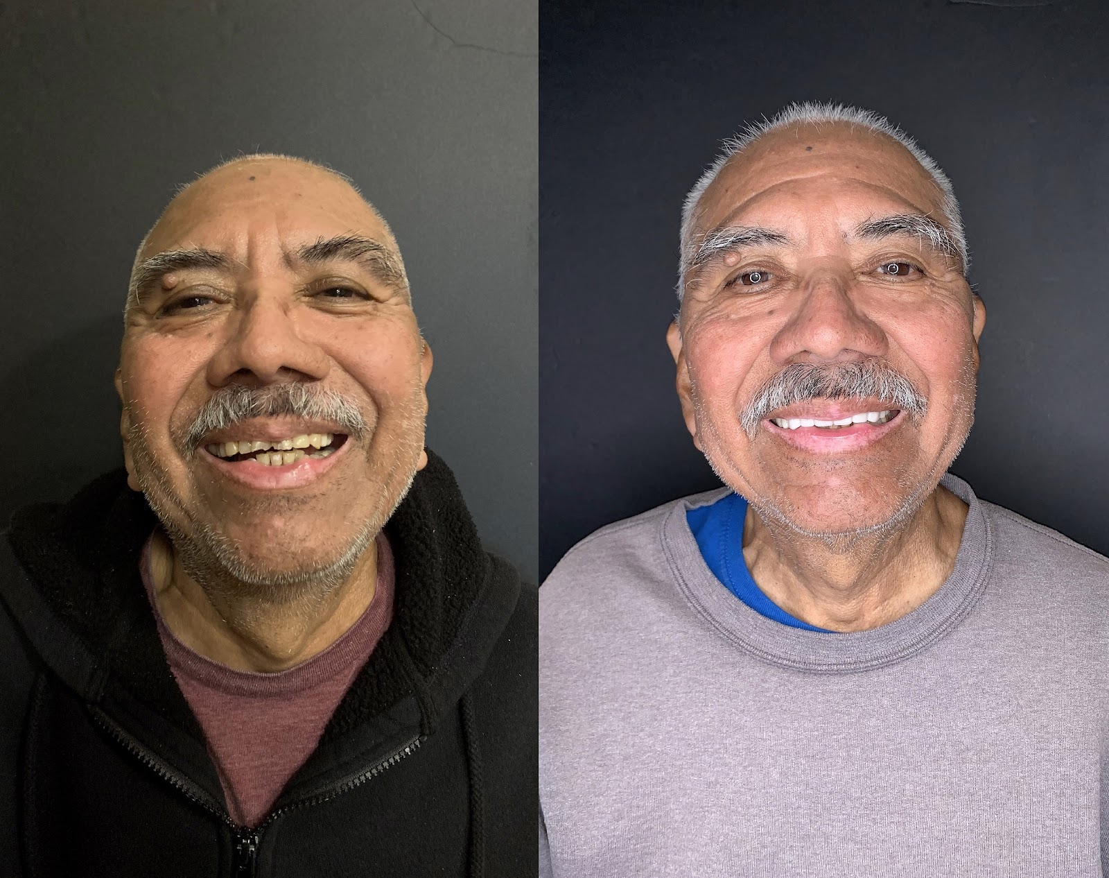 Patient smile result