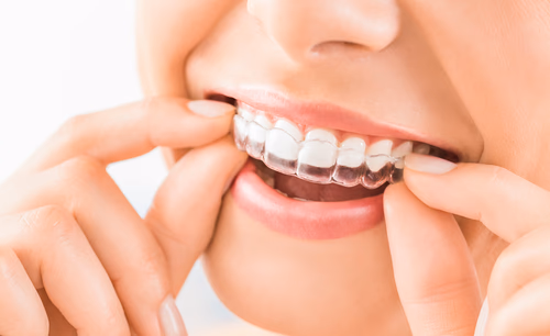 Clear Aligners Treatment