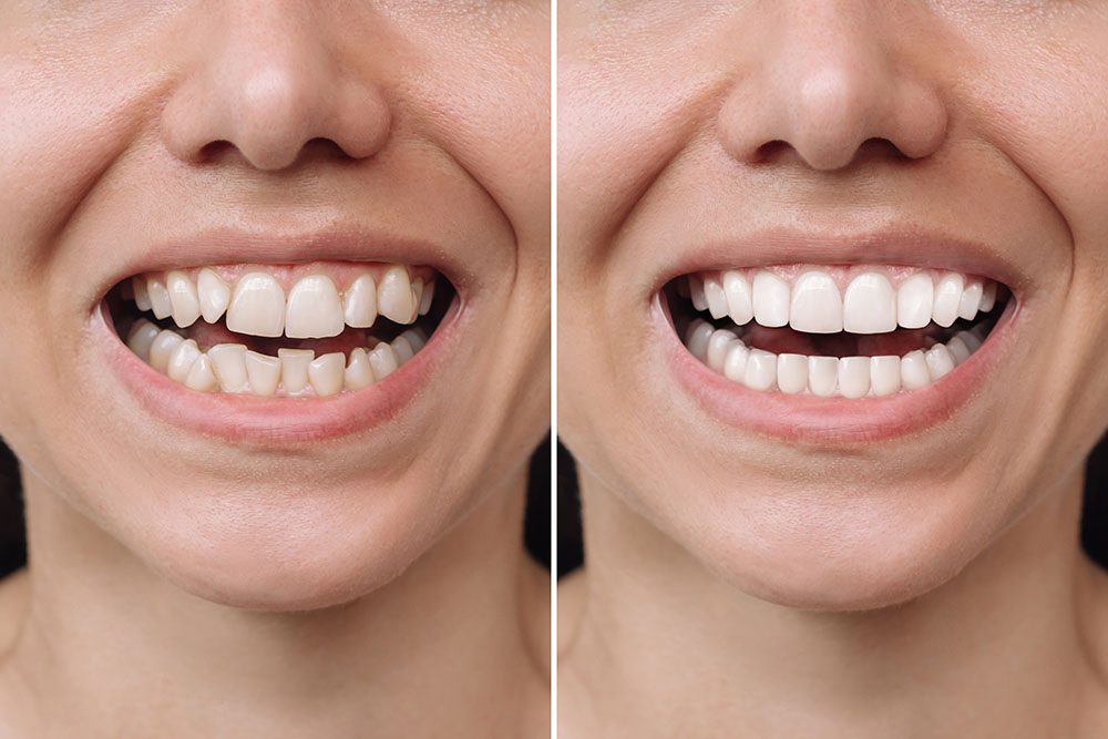 Dental Veneers Treatment