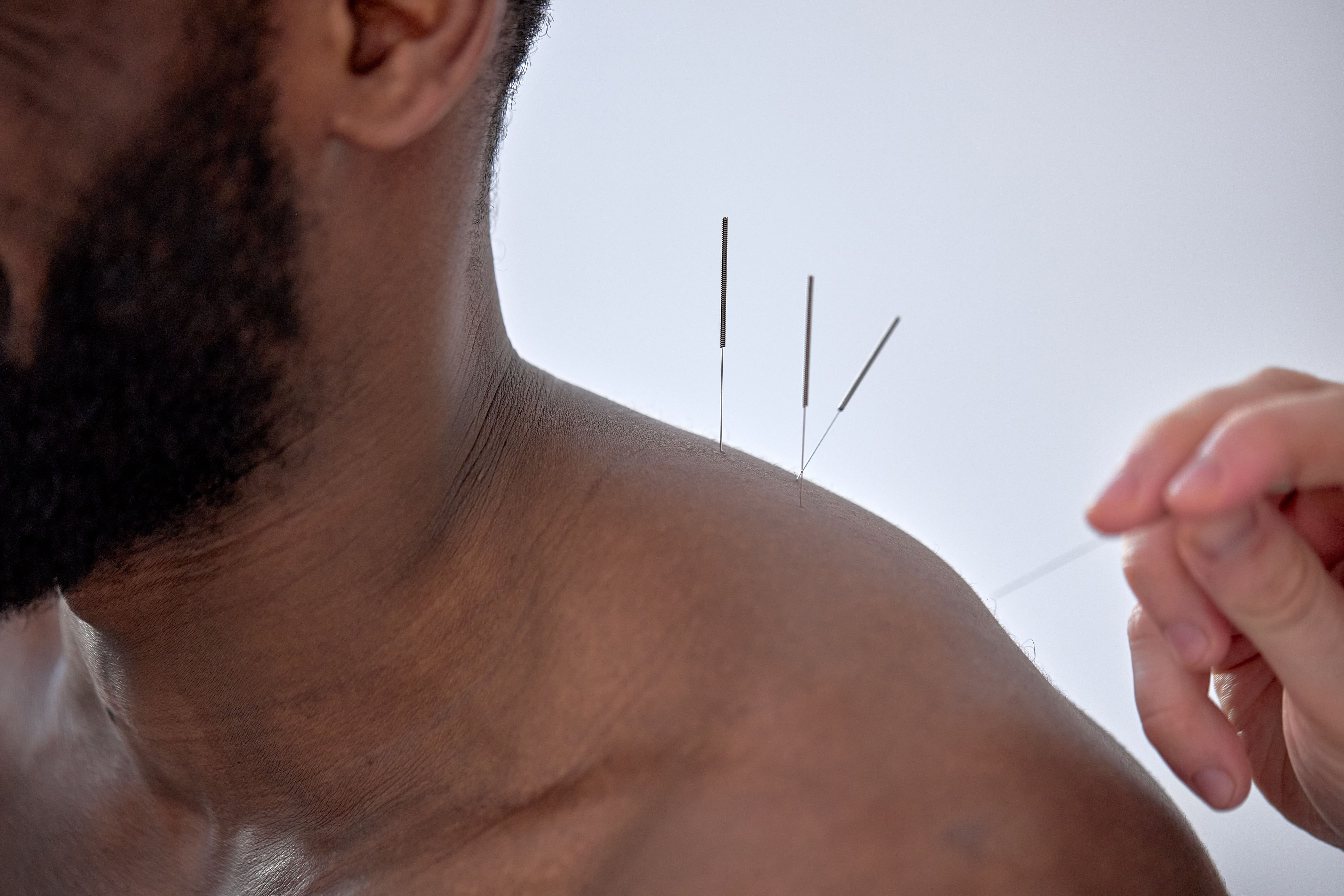 Chiropractor performing acupuncture treatment on a patient at Crown Chiro in Regina.