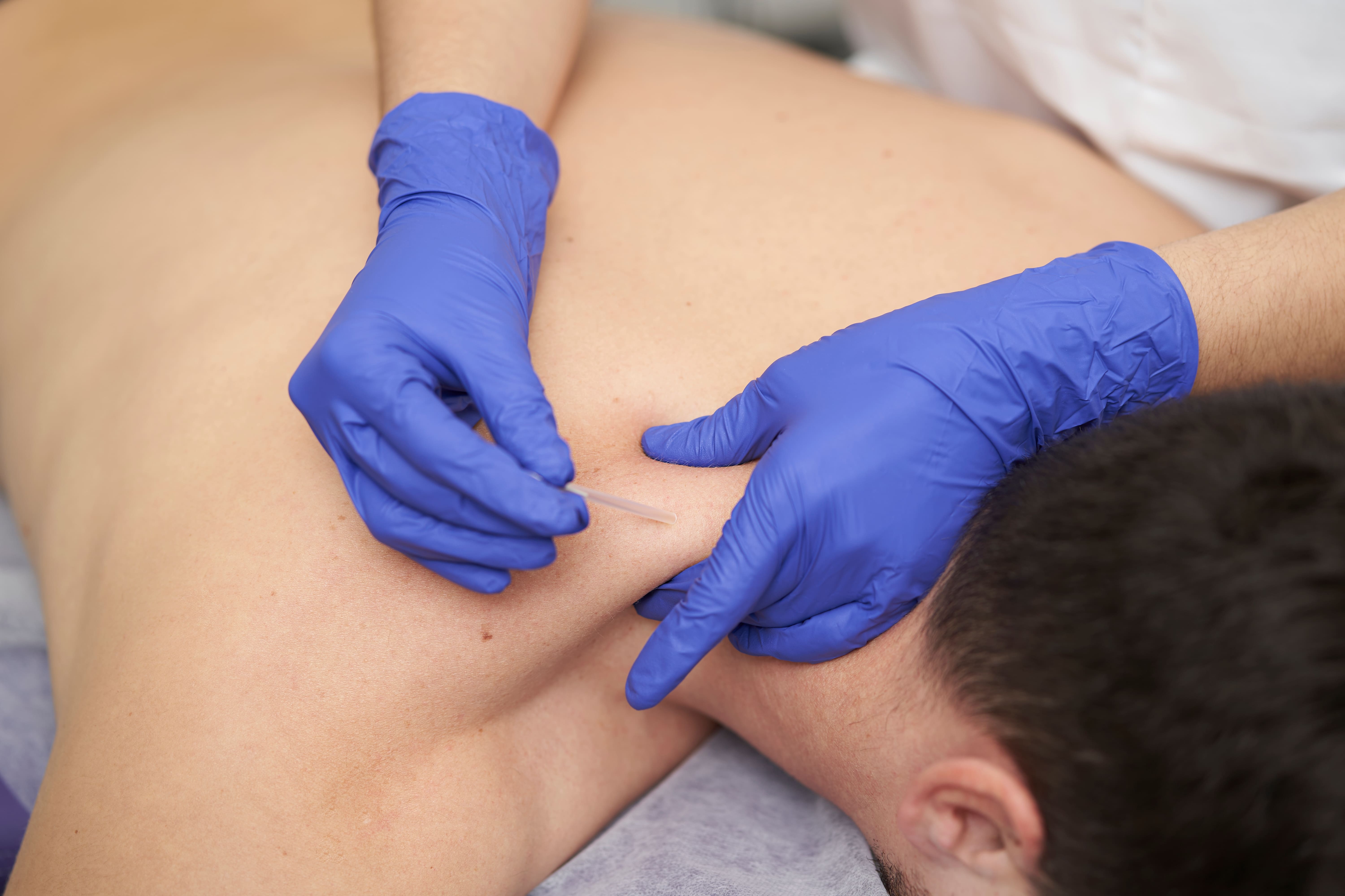 Chiropractor performing acupuncture treatment on a patient at Crown Chiro in Regina.