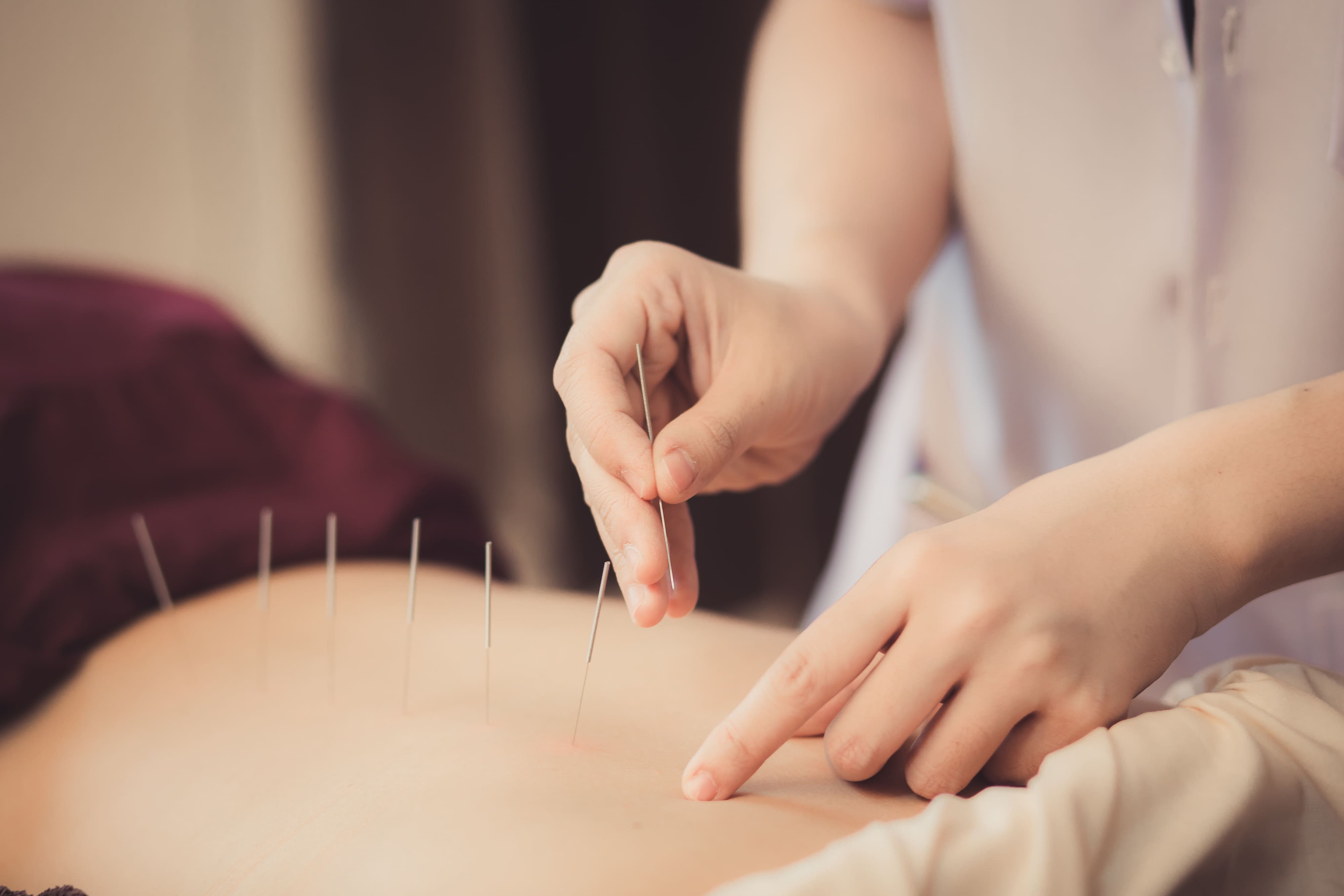 Chiropractor performing acupuncture treatment on a patient at Crown Chiro in Regina.