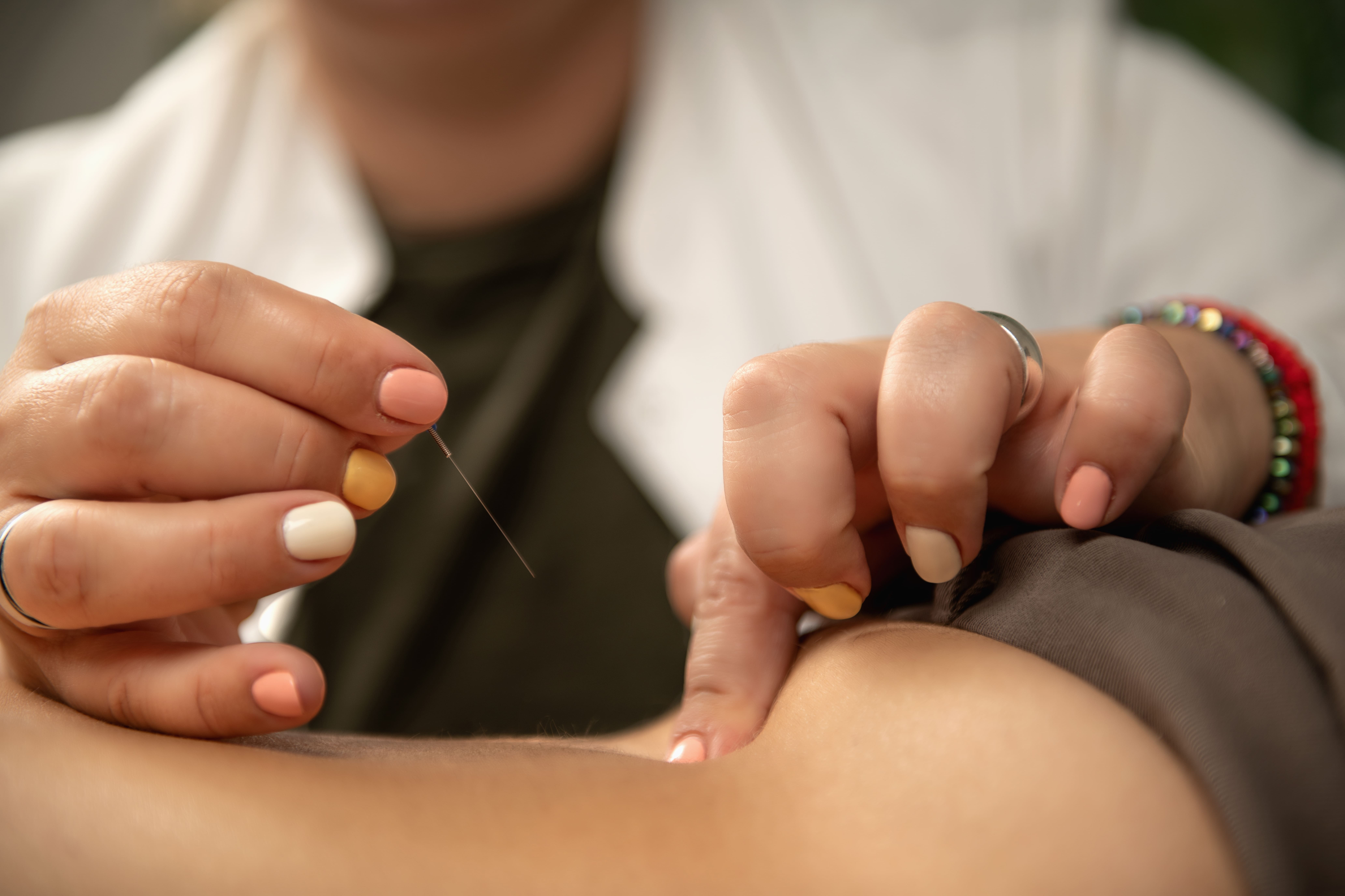 Chiropractor performing acupuncture treatment on a patient at Crown Chiro in Regina.