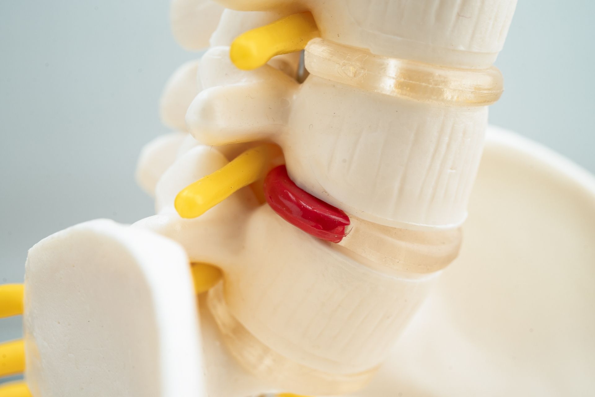 Spinal Disc Herniation Physical Therapy​ in Spanish Fork, Utah