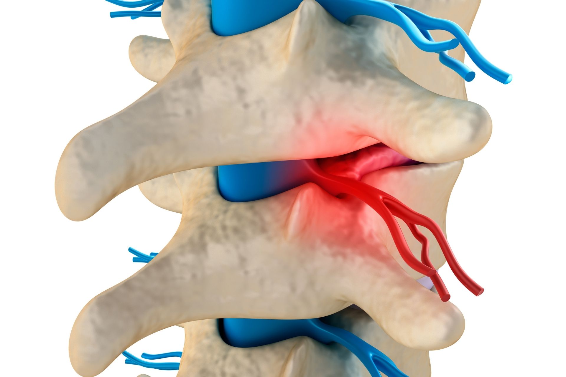 Spinal Decompression in Spanish Fork, Utah