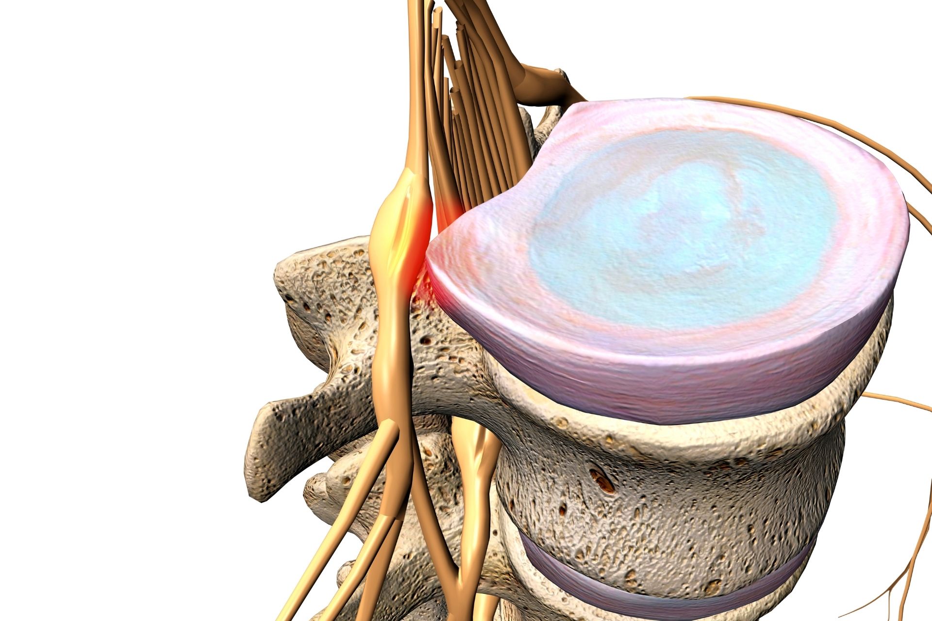 Mapleton, Utah Spinal Disc Herniation Physical Therapy​