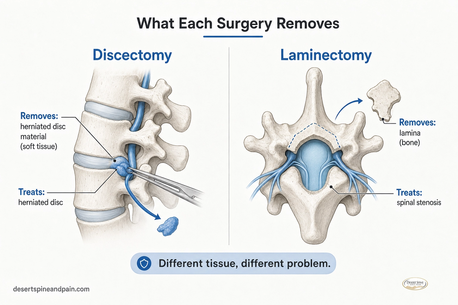 Split-panel infographic comparing a discectomy removing disc material and a laminectomy removing the lamina bone Split-panel infographic comparing a discectomy removing disc material and a laminectomy removing the lamina bone