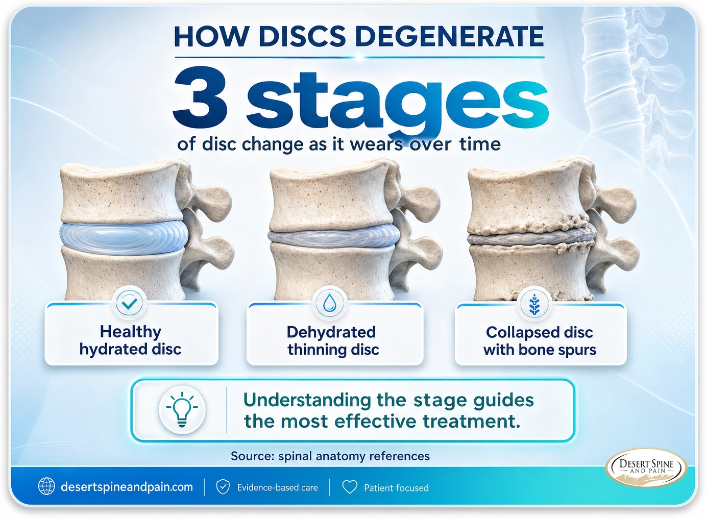 Degenerative disc disease: three stages from a healthy hydrated disc to a dehydrated thinning disc to a collapsed disc with bone spurs