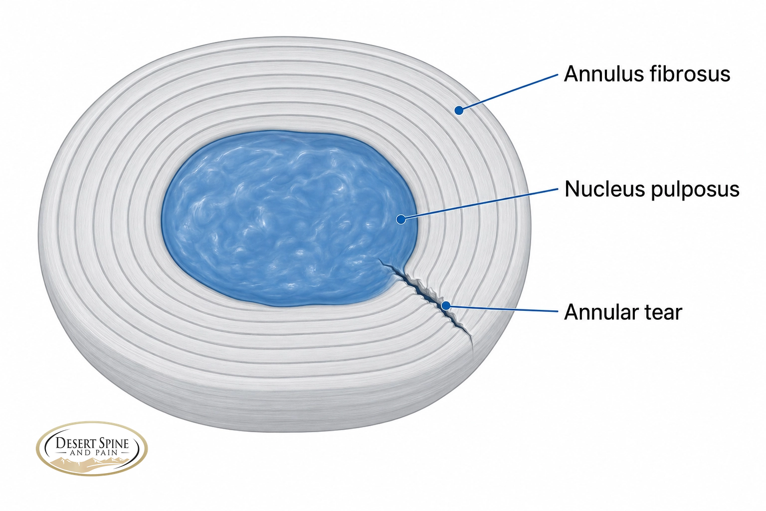 Axial cross-section of a spinal disc labeling the annulus fibrosus, nucleus pulposus, and an annular tear