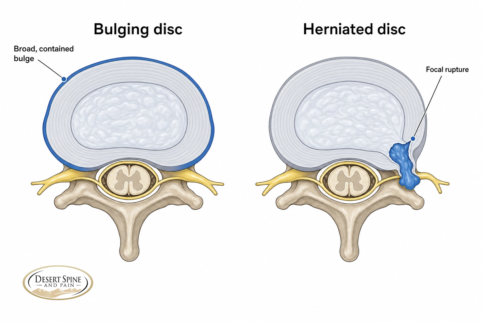 Axial comparison of a broad, contained bulging disc versus a focal herniated disc rupture