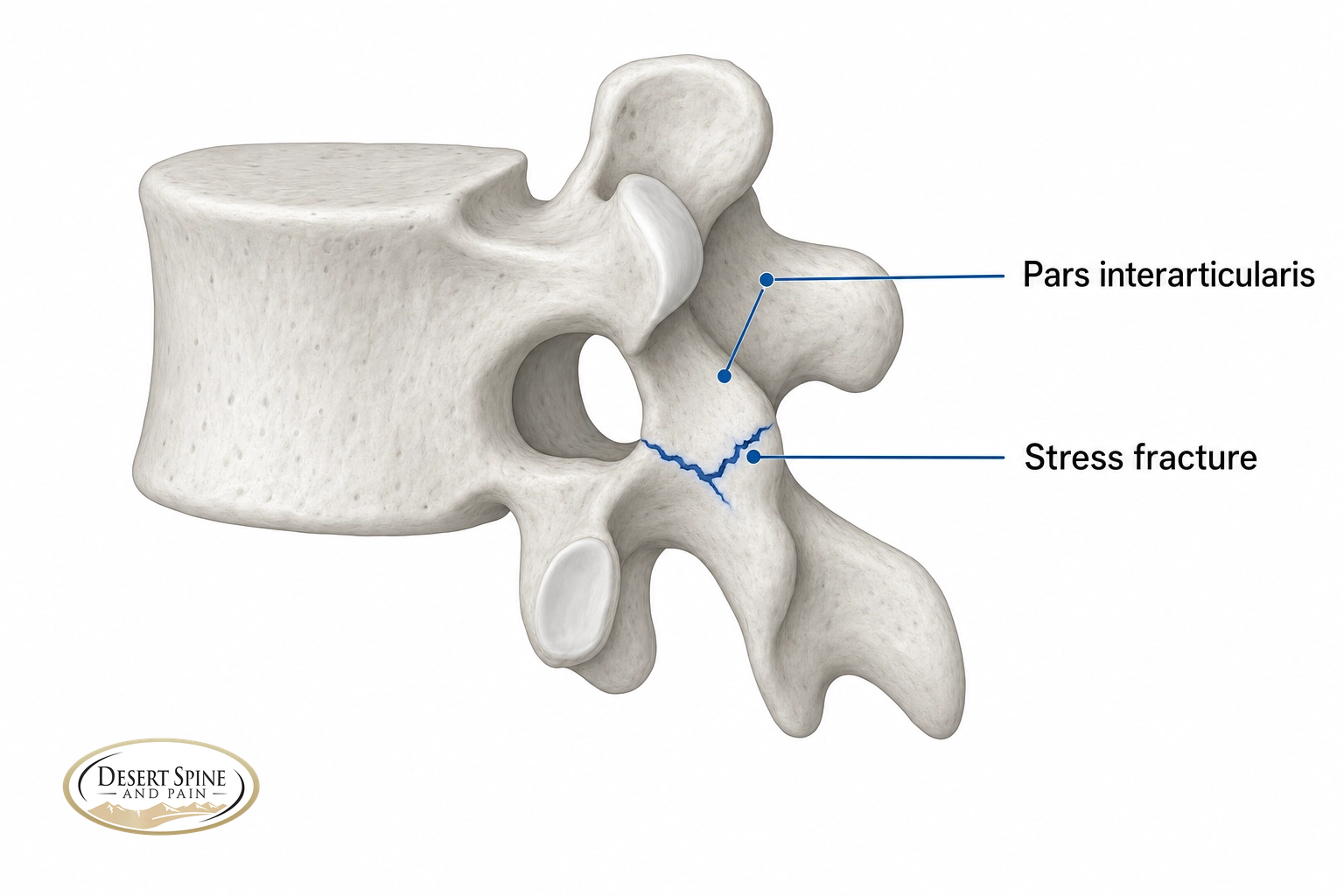 Diagram of a lumbar vertebra with a stress fracture in the pars interarticularis
