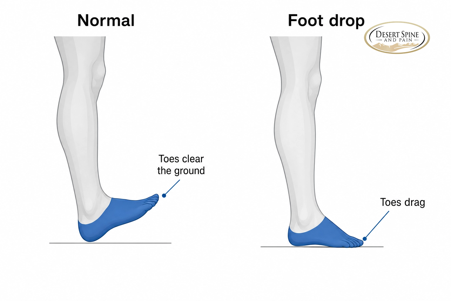Comparison of a normal foot lifting to clear the ground versus a dropped foot with toes dragging
