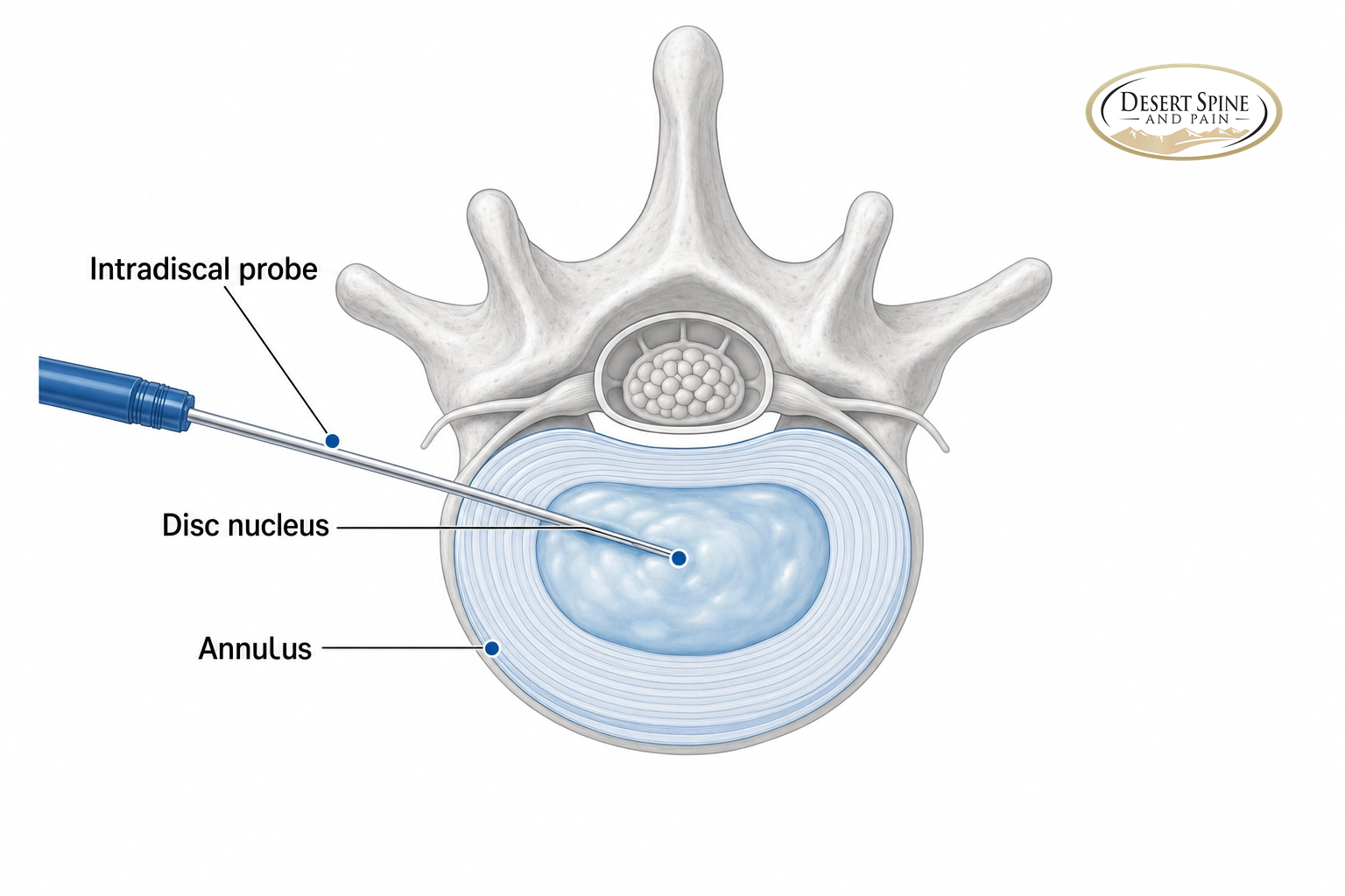 Disc cross-section showing a thin probe inside the disc nucleus