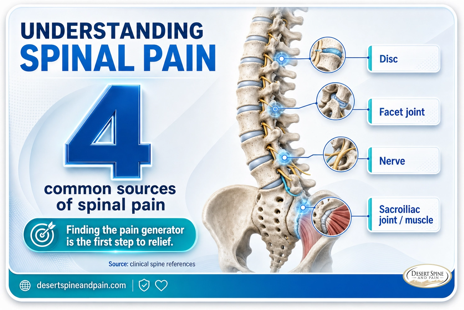 Spinal pain: four common sources are the disc, facet joint, nerve, and sacroiliac joint or muscle