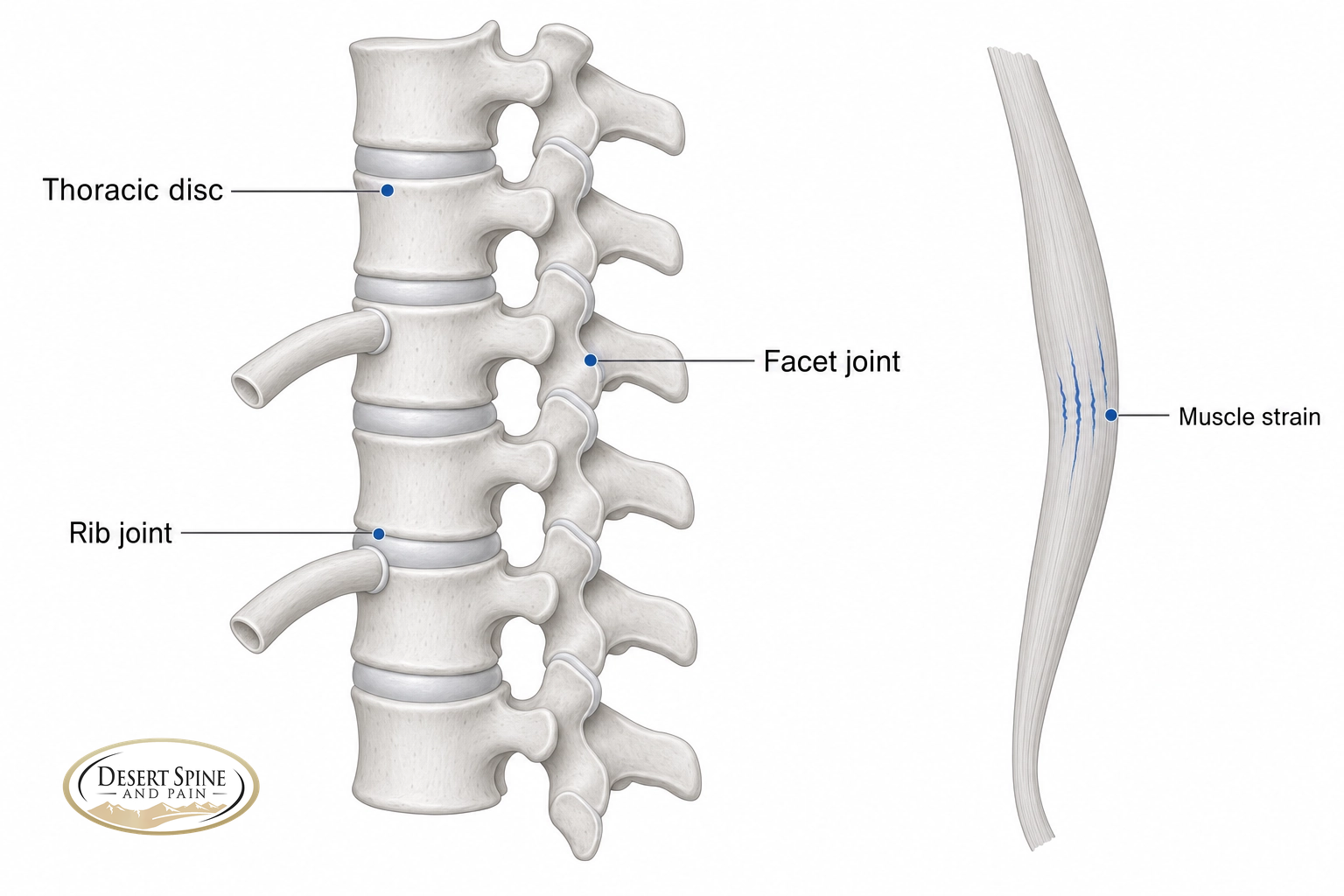 Thoracic spine diagram labeling a thoracic disc, facet joint, rib joint, and muscle strain as common sources of upper back pain