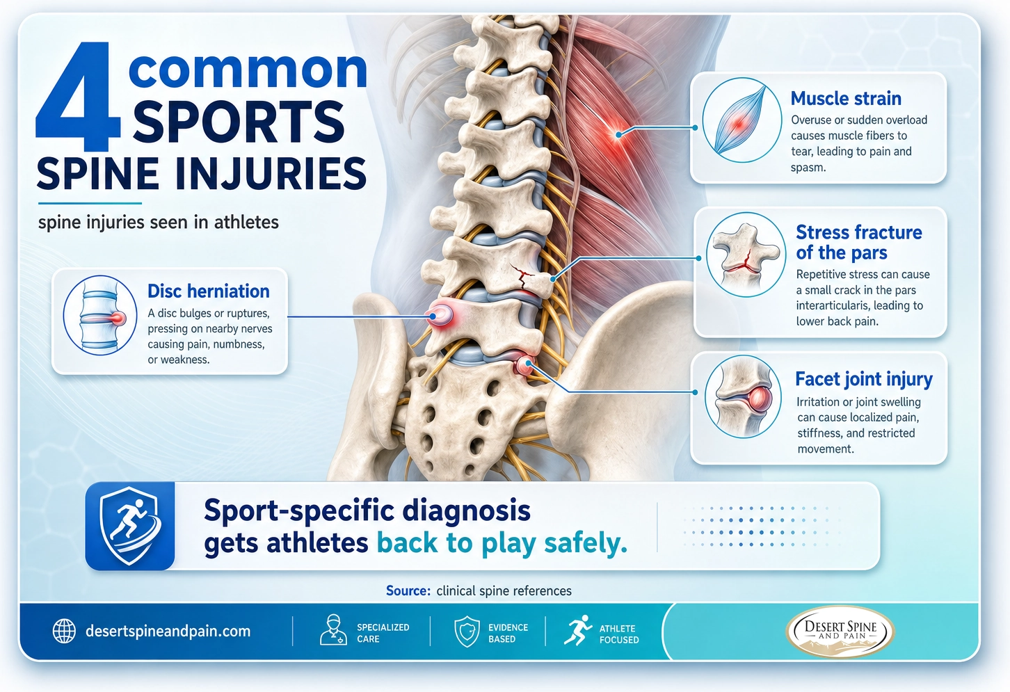 Common sports spine injuries: disc herniation, muscle strain, pars stress fracture, and facet joint injury