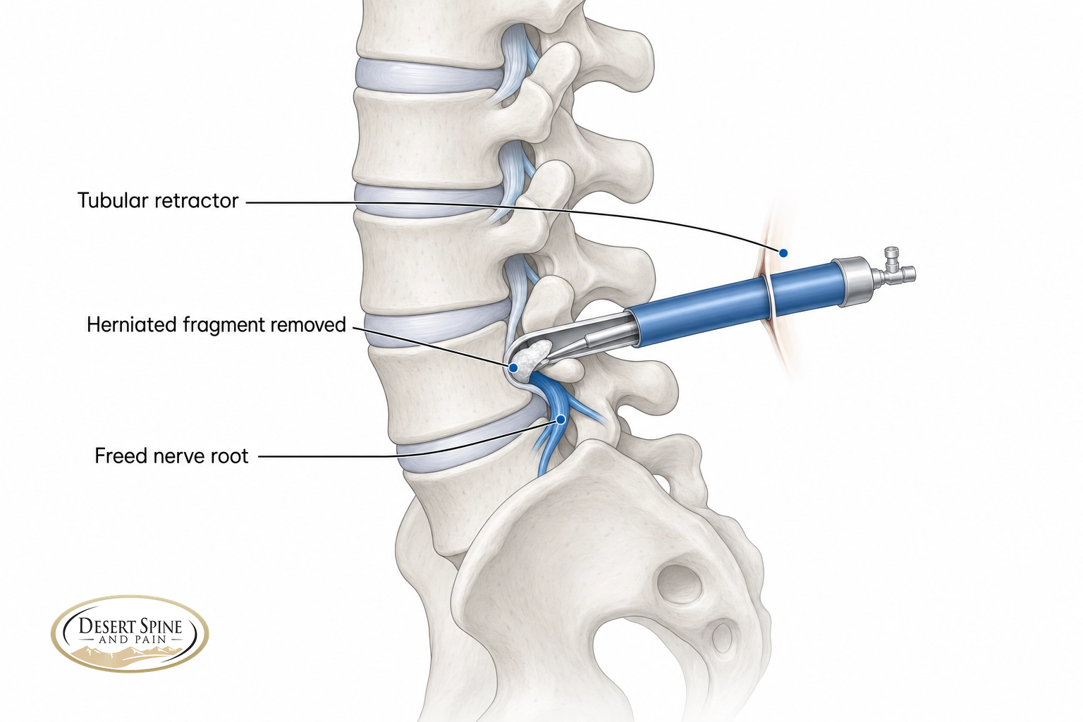 Lumbar spine diagram showing a tubular retractor and a herniated disc fragment removed from a nerve root