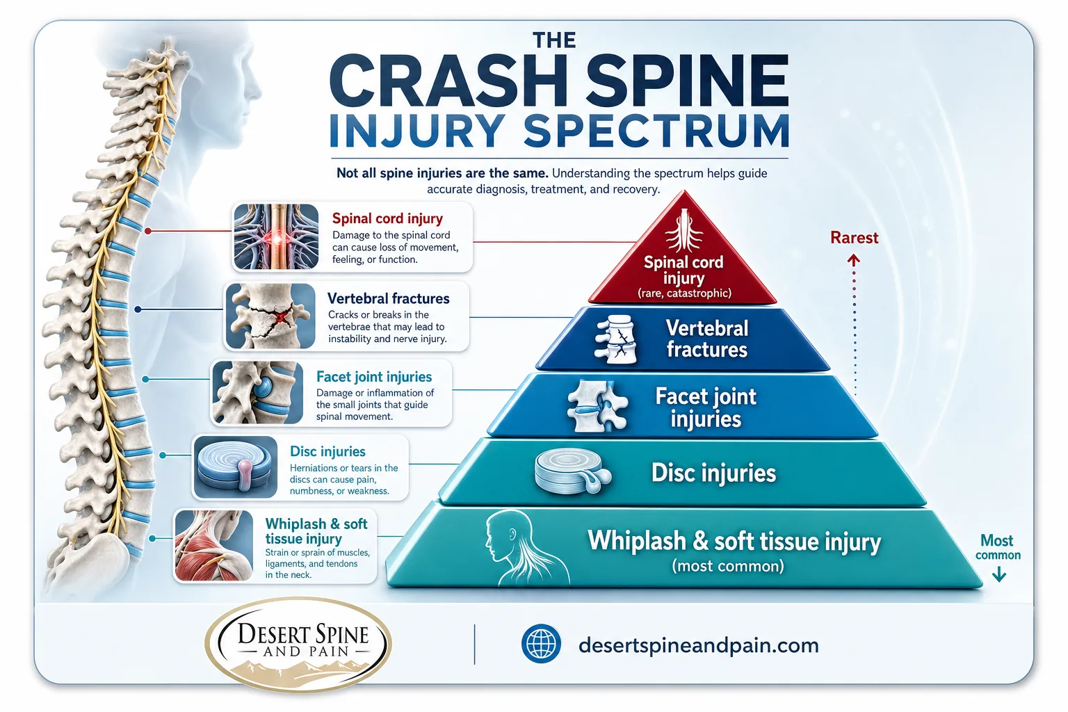 Medical pyramid diagram of crash spine injury spectrum from whiplash to spinal cord injury