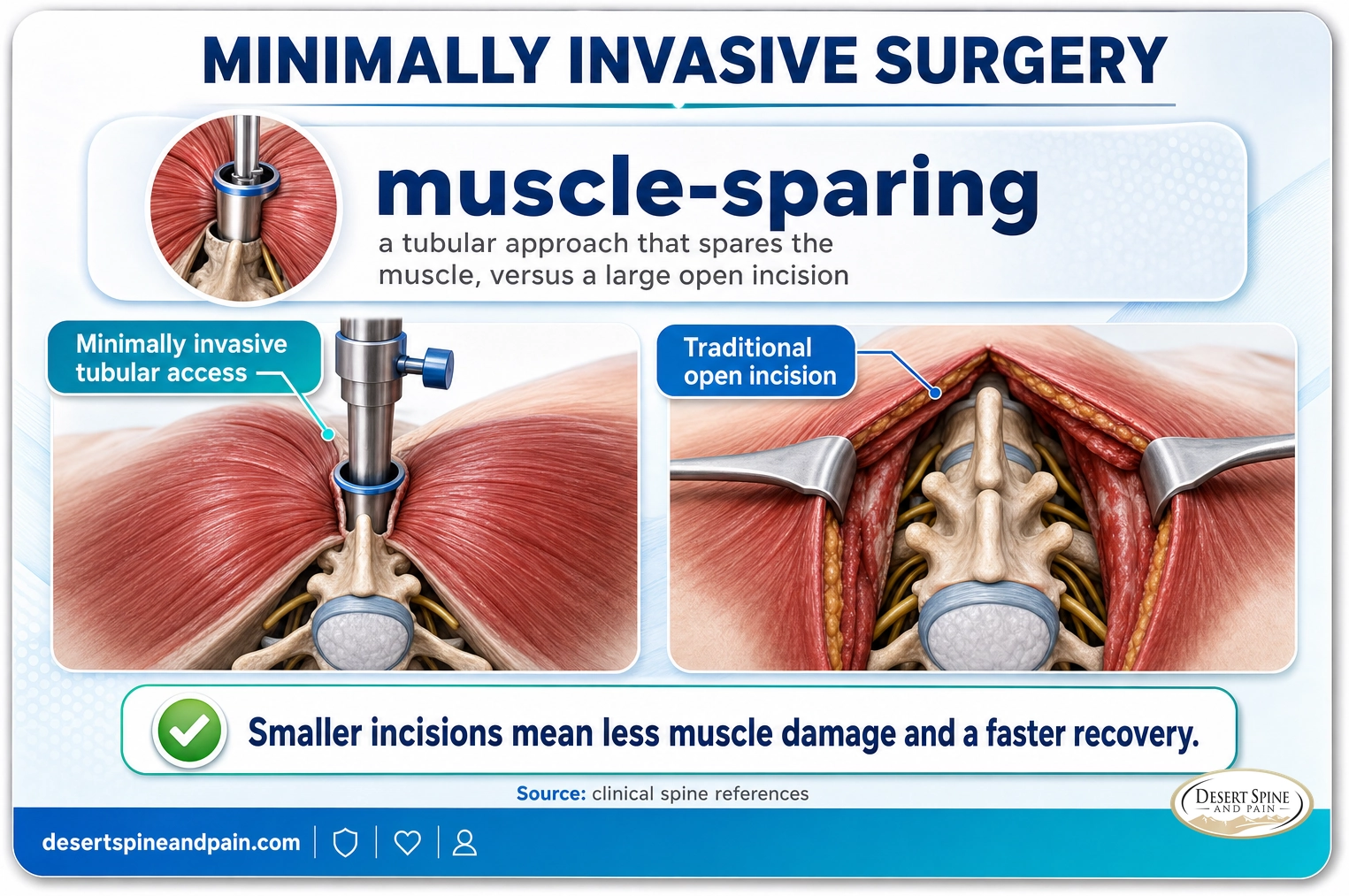 Minimally invasive surgery: a small muscle-sparing tubular approach versus a large open incision, meaning less muscle damage and faster recovery