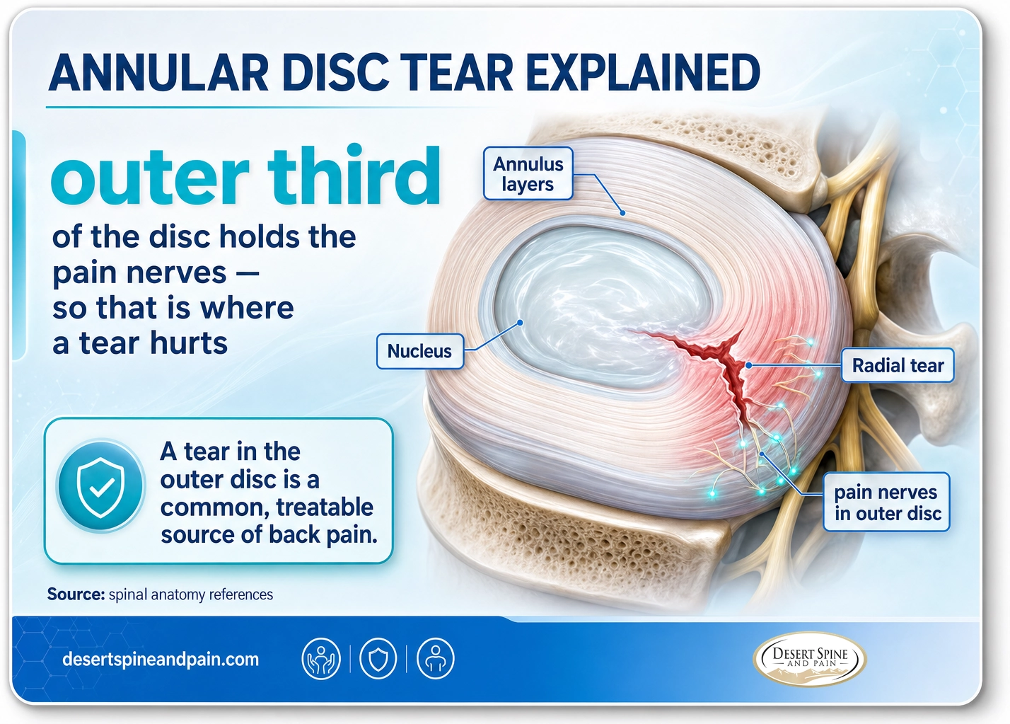 Annular disc tear: only the outer third of the disc has pain nerves, so a tear reaching that layer is what causes pain