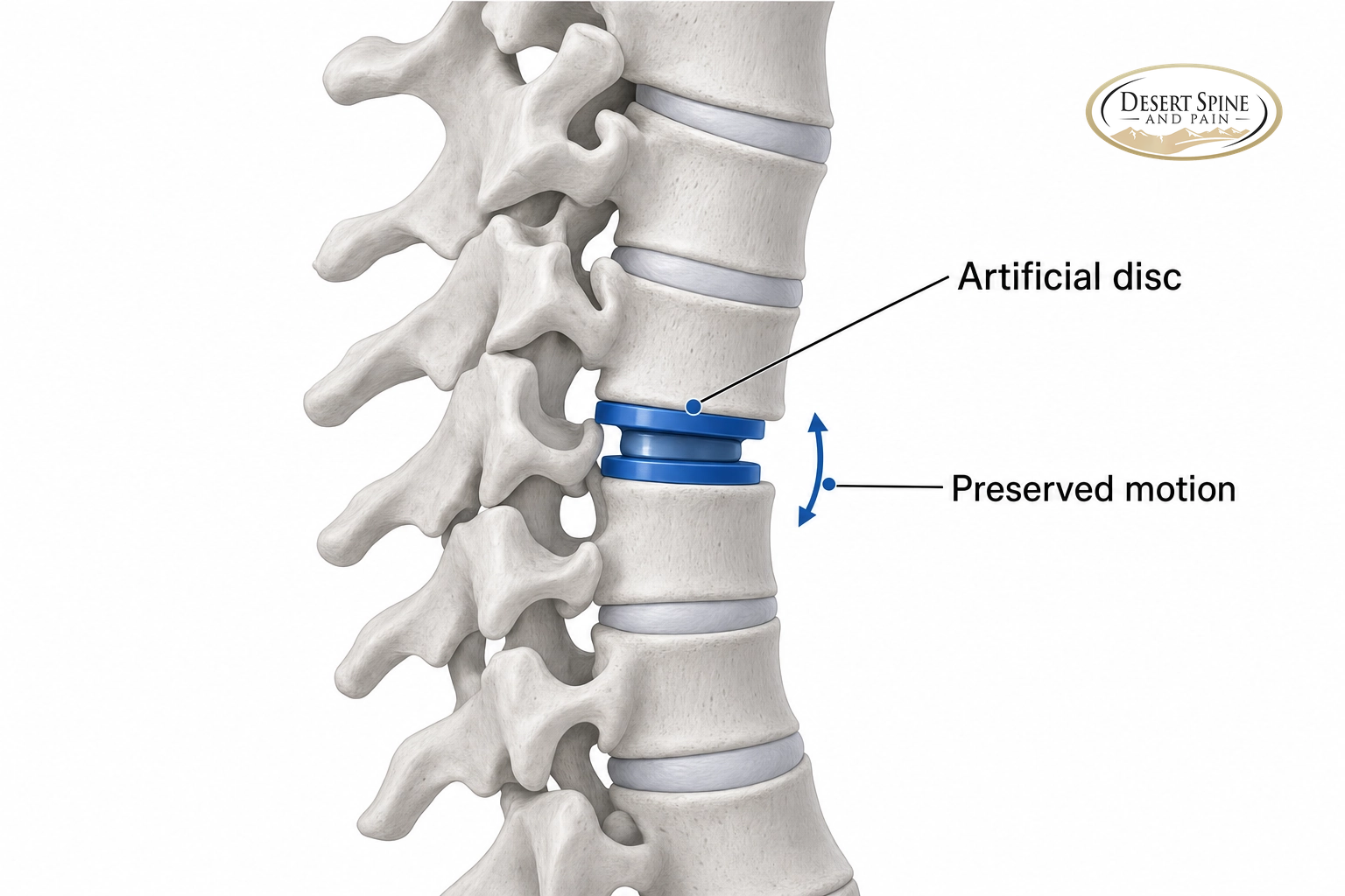 Cervical spine diagram showing a damaged disc replaced with a motion-preserving artificial disc