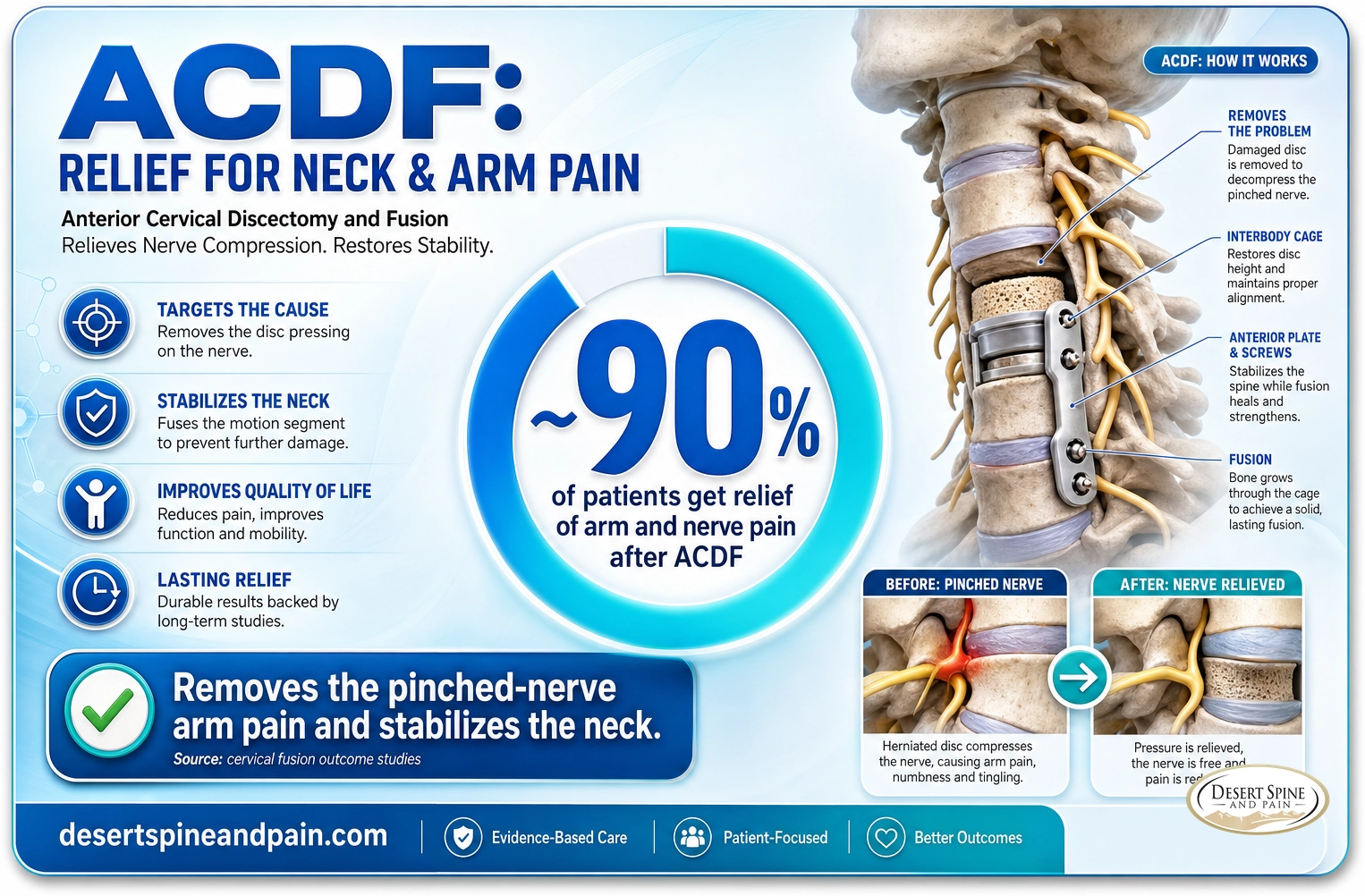 ACDF: about 90 percent of patients get relief of arm and nerve pain