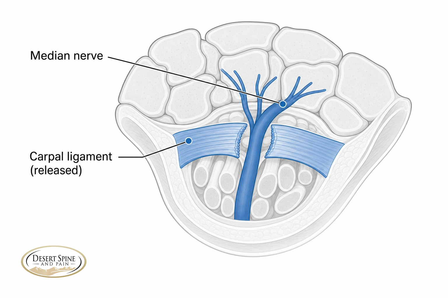 Wrist cross-section showing the median nerve under the carpal ligament, which is released
