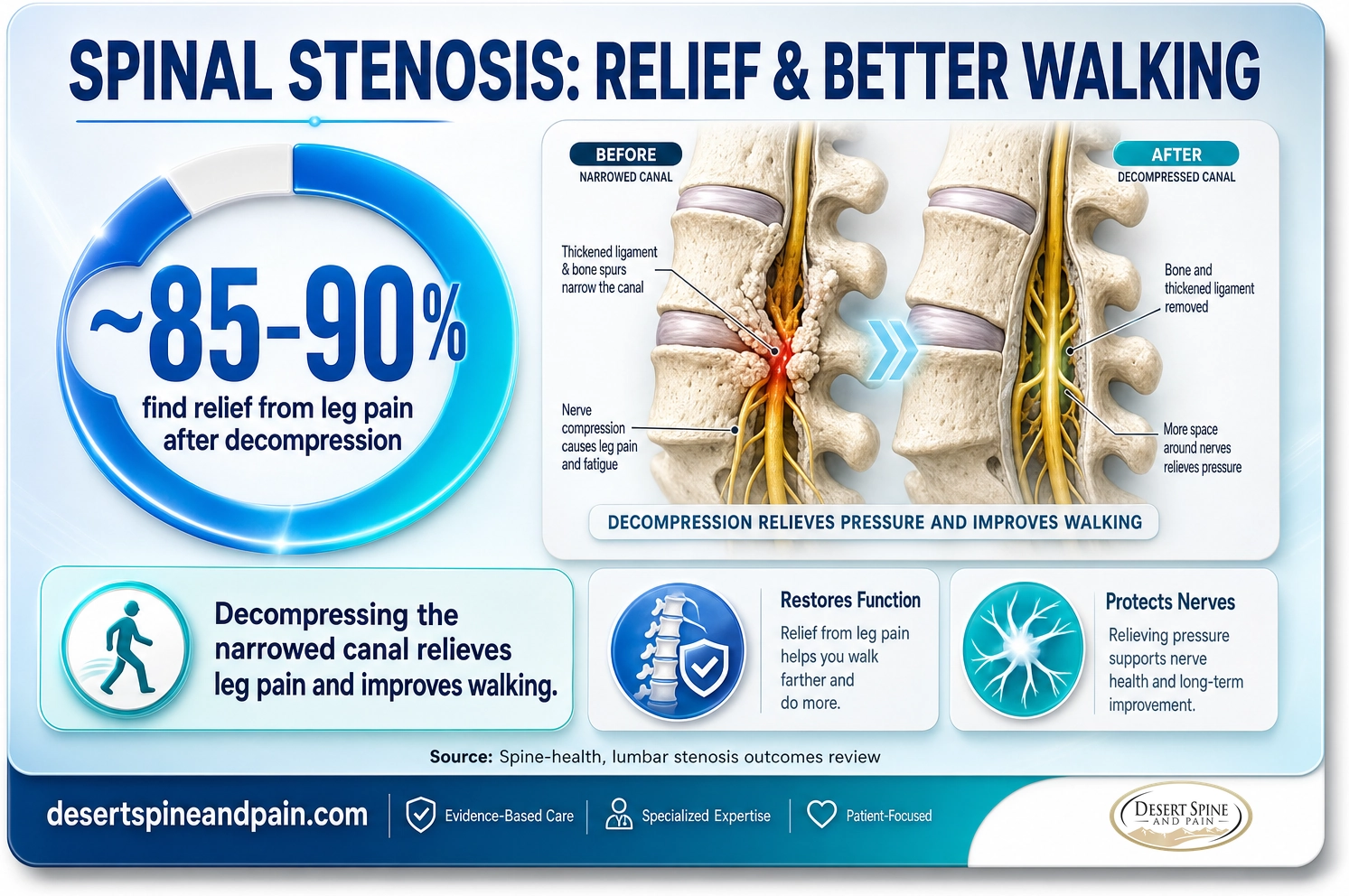 Spinal stenosis: about 85 to 90 percent find relief from leg pain after decompression